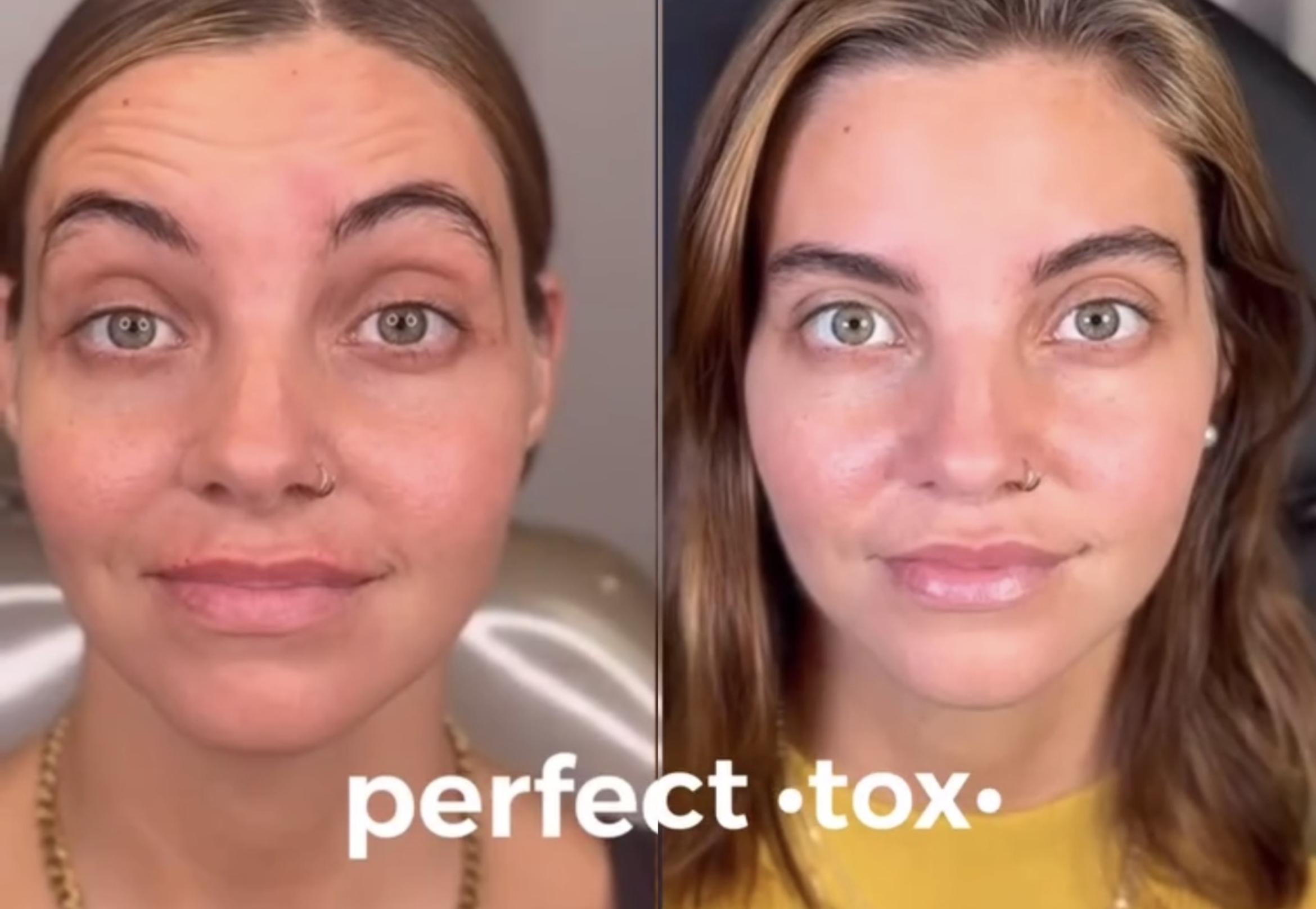 Forehead Botox