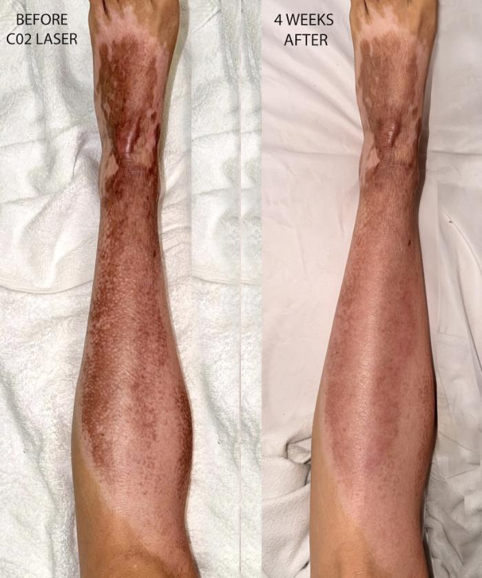 c02 Laser for Second Degree Burns