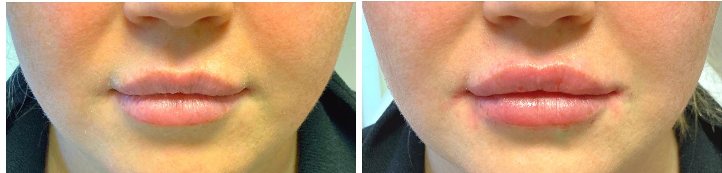 Natural Lip Augmentation