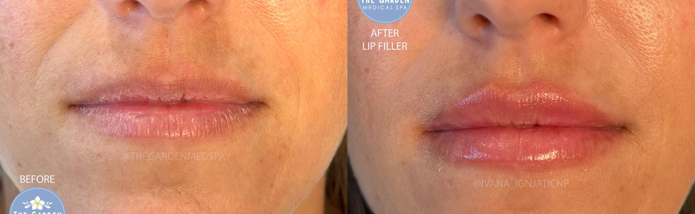 First Time Lip Filler