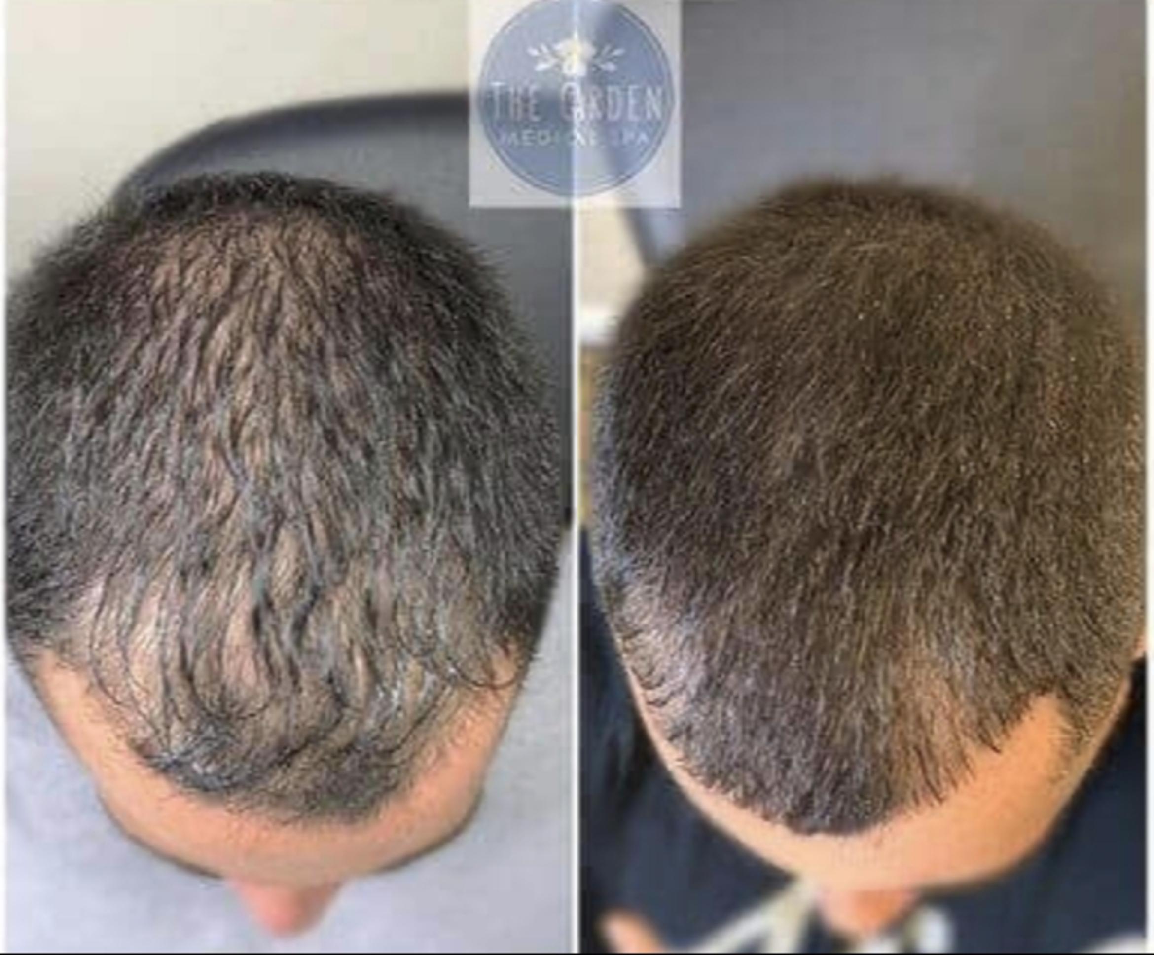 Hair Restoration After 2 Sessions