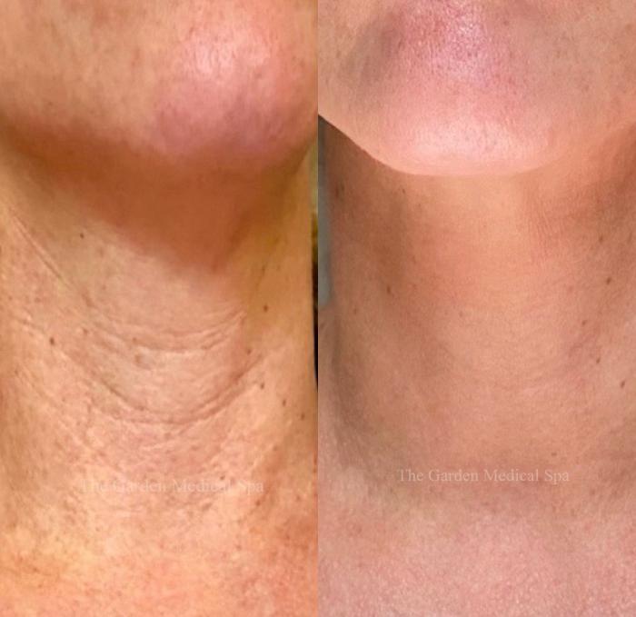 Neck Wrinkles Soften with Microneedling