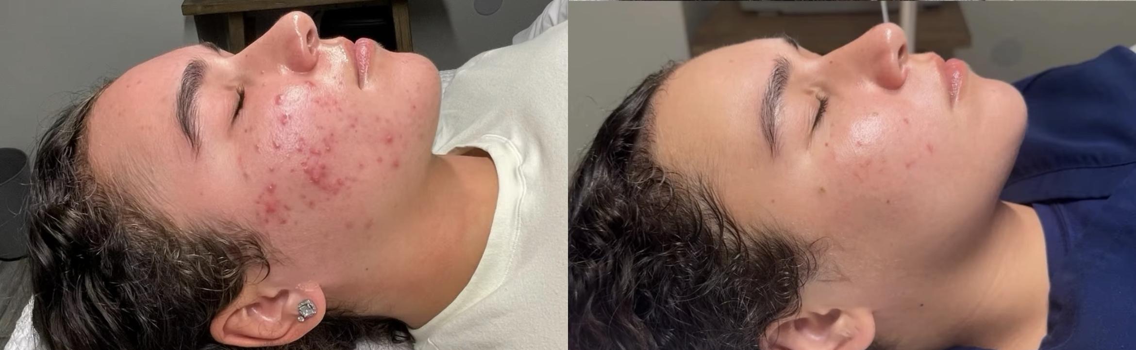 Microneedling
