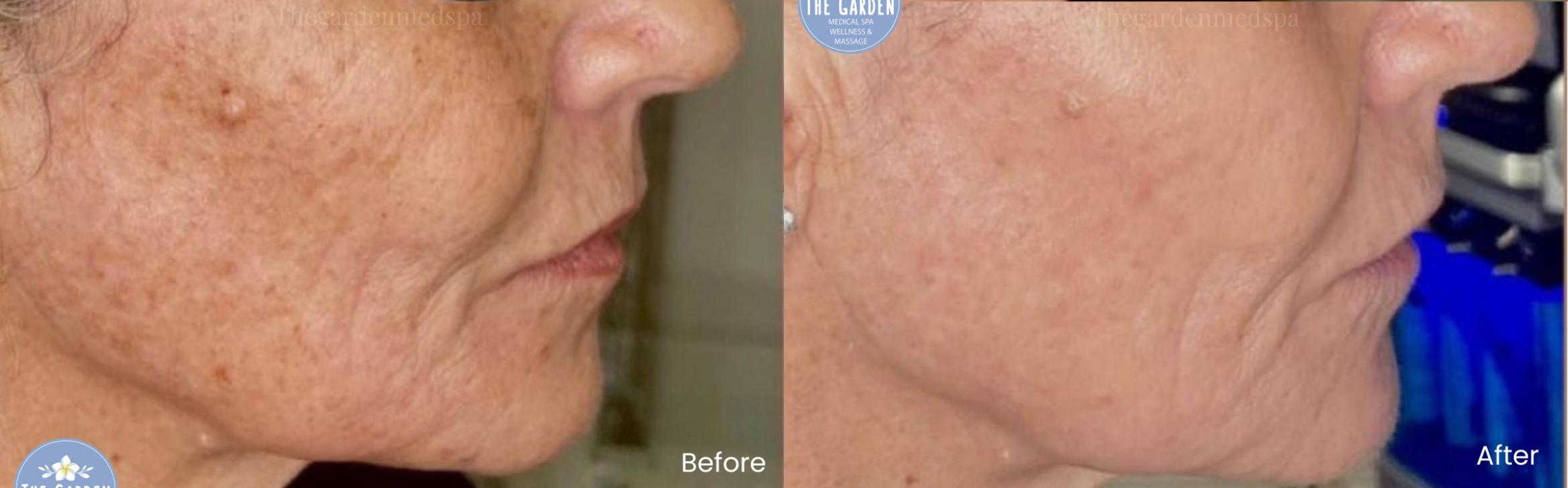 Sun Damage Removal with Smoothglo