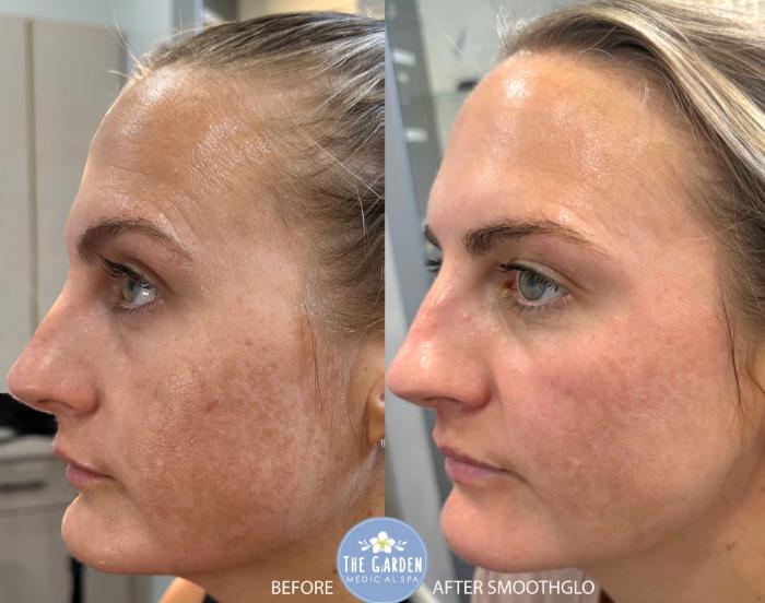 SmoothGlo for Visible Sun Damage