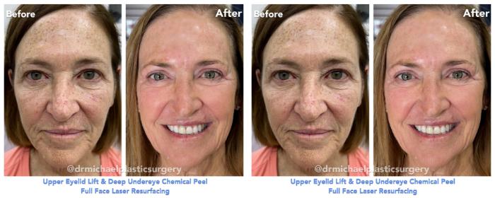 SmoothTone with Upper Bleph & Chemical Peel