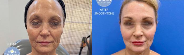 SmoothTone