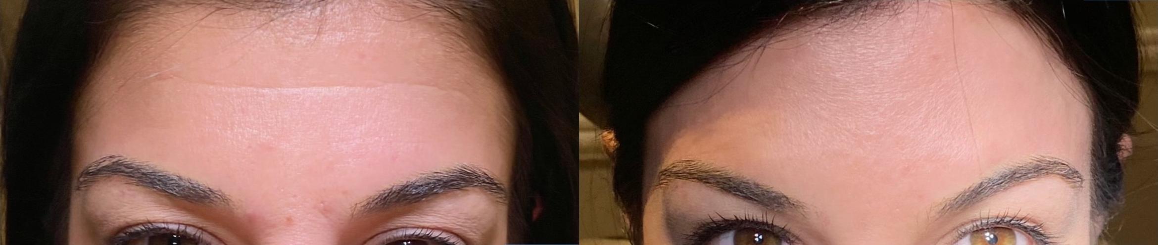 Before & After BOTOX® Cosmetic Client #13 Front View in Tampa Bay, North Palm Beach, FL