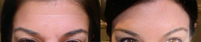 Before & After BOTOX® Cosmetic Client #13 Front View in Tampa Bay, North Palm Beach, FL