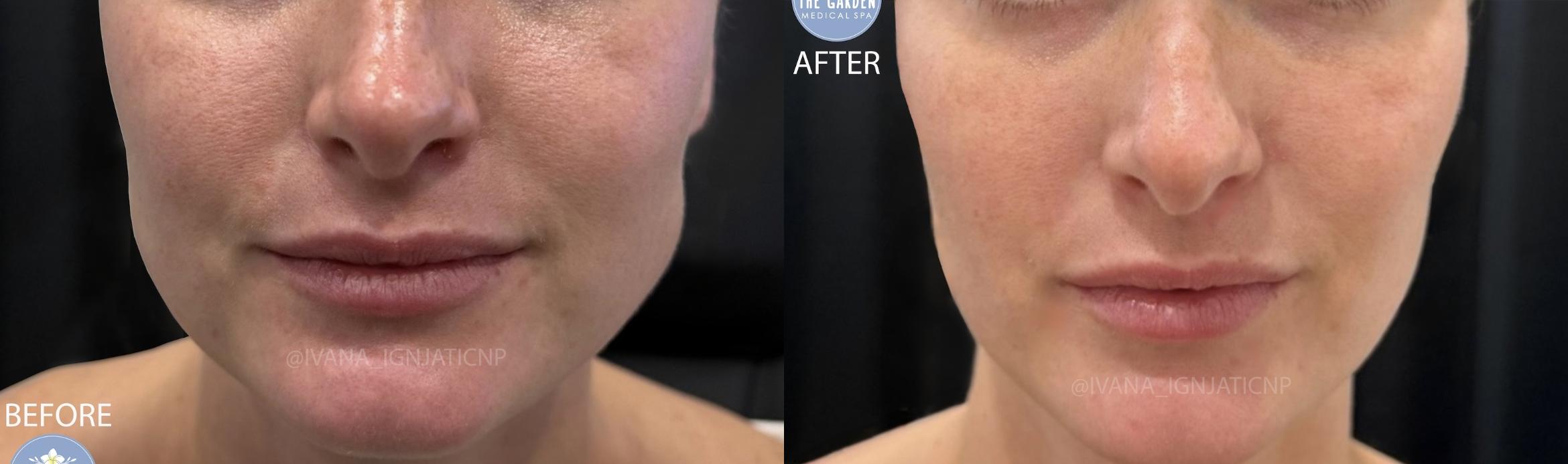 Jaw Slimming with Botox
