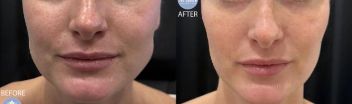 Jaw Slimming with Botox