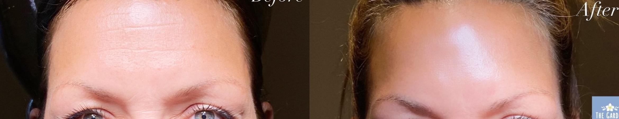 Before & After BOTOX® Cosmetic Client #18 Front View in Tampa Bay, North Palm Beach, FL