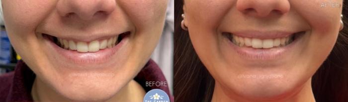 Lip Flip with Botox