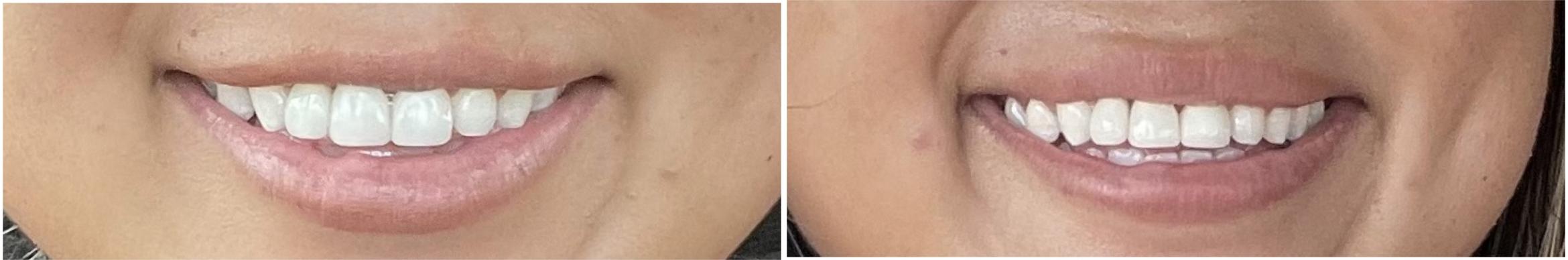 Before & After BOTOX® Cosmetic Client #61 Front View in Tampa Bay, North Palm Beach, FL