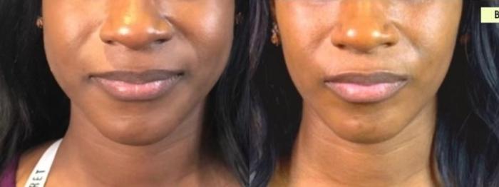 Before & After BOTOX® Cosmetic Client #73 Front View in Tampa Bay, North Palm Beach, FL