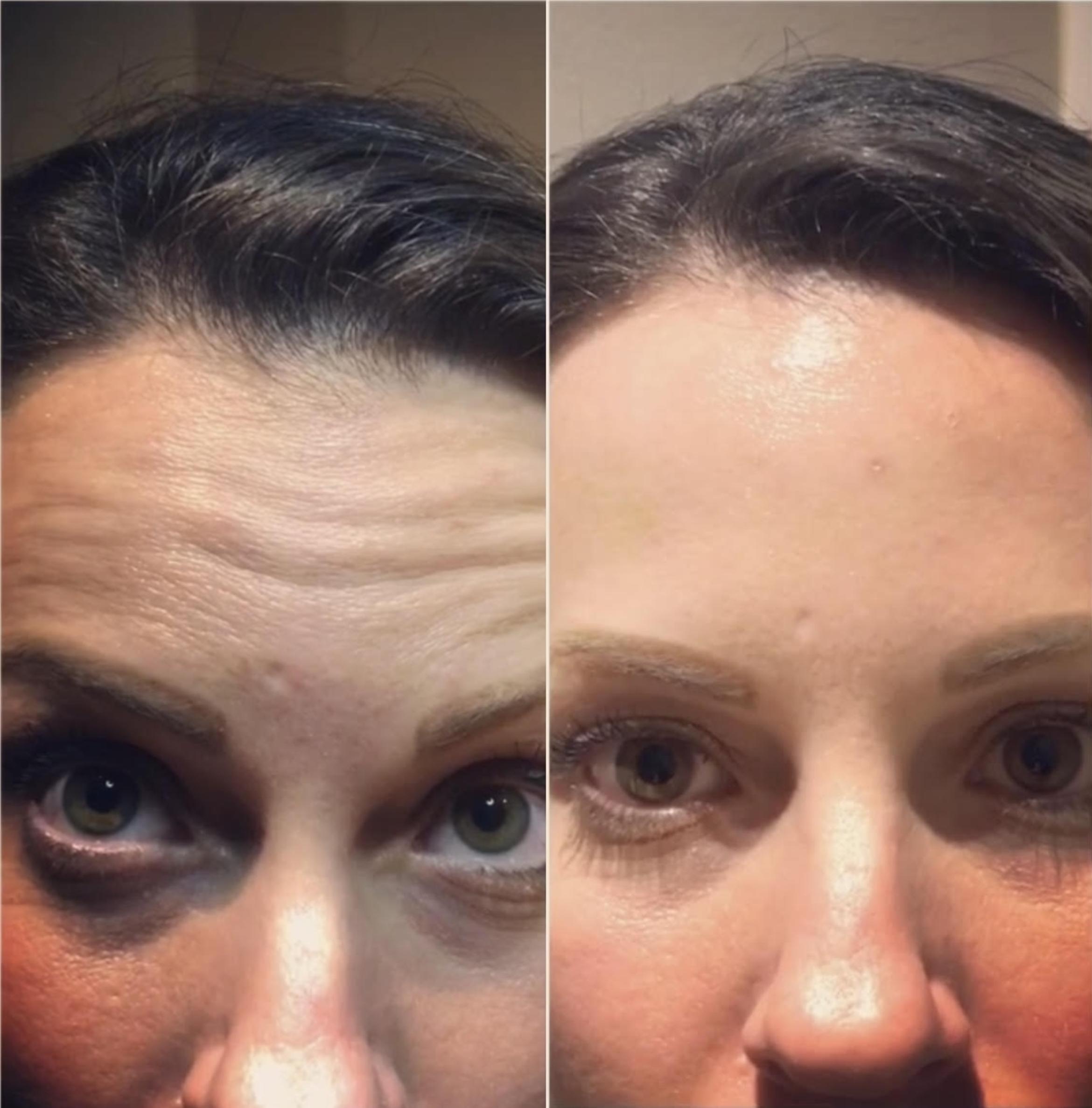 Before & After BOTOX® Cosmetic Client #87 Front View in Tampa Bay, North Palm Beach, FL