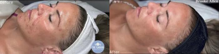 Acne & Acne Scar Chemical Peel