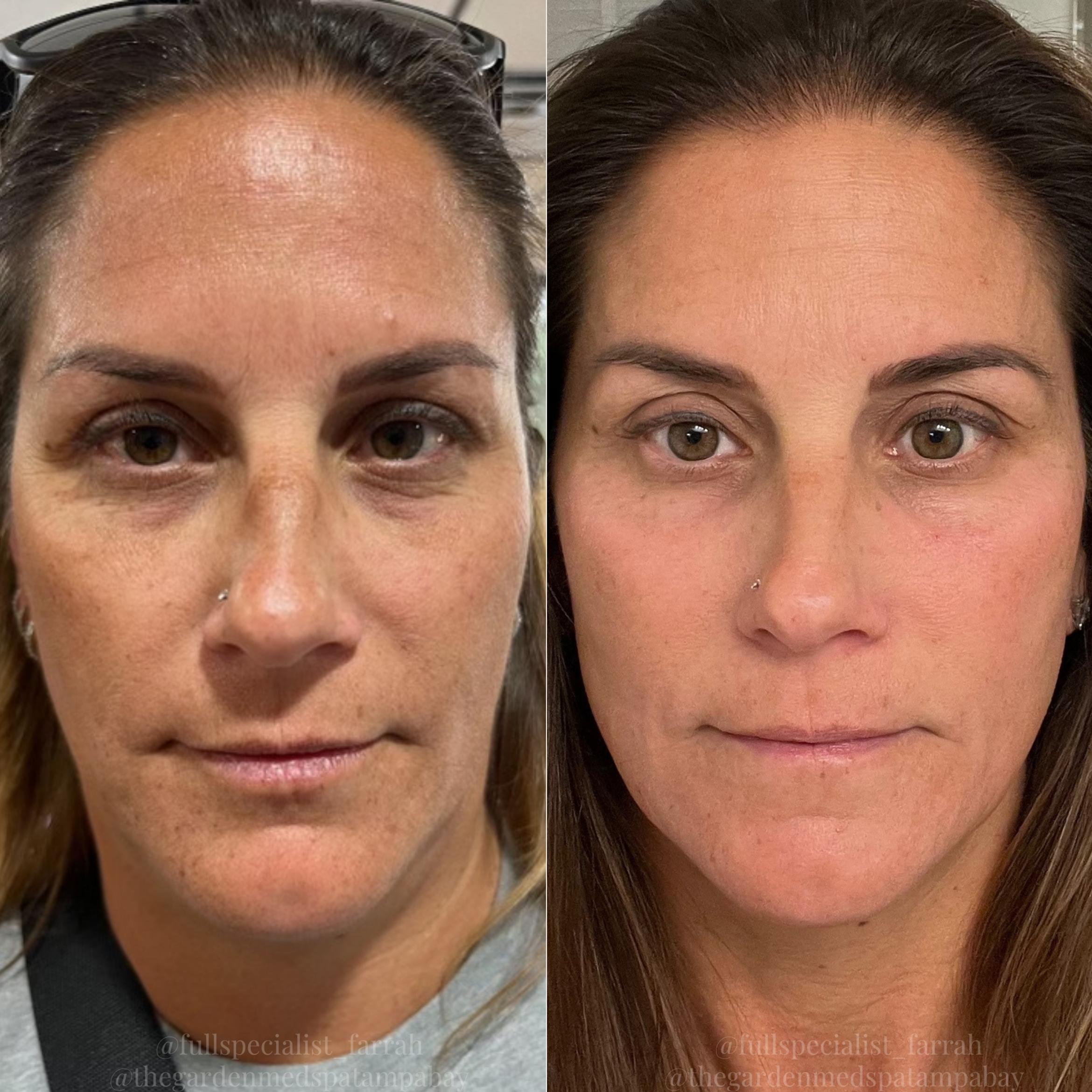 Before & After Chemical Peels Client #28 Front View in Tampa Bay, North Palm Beach, FL