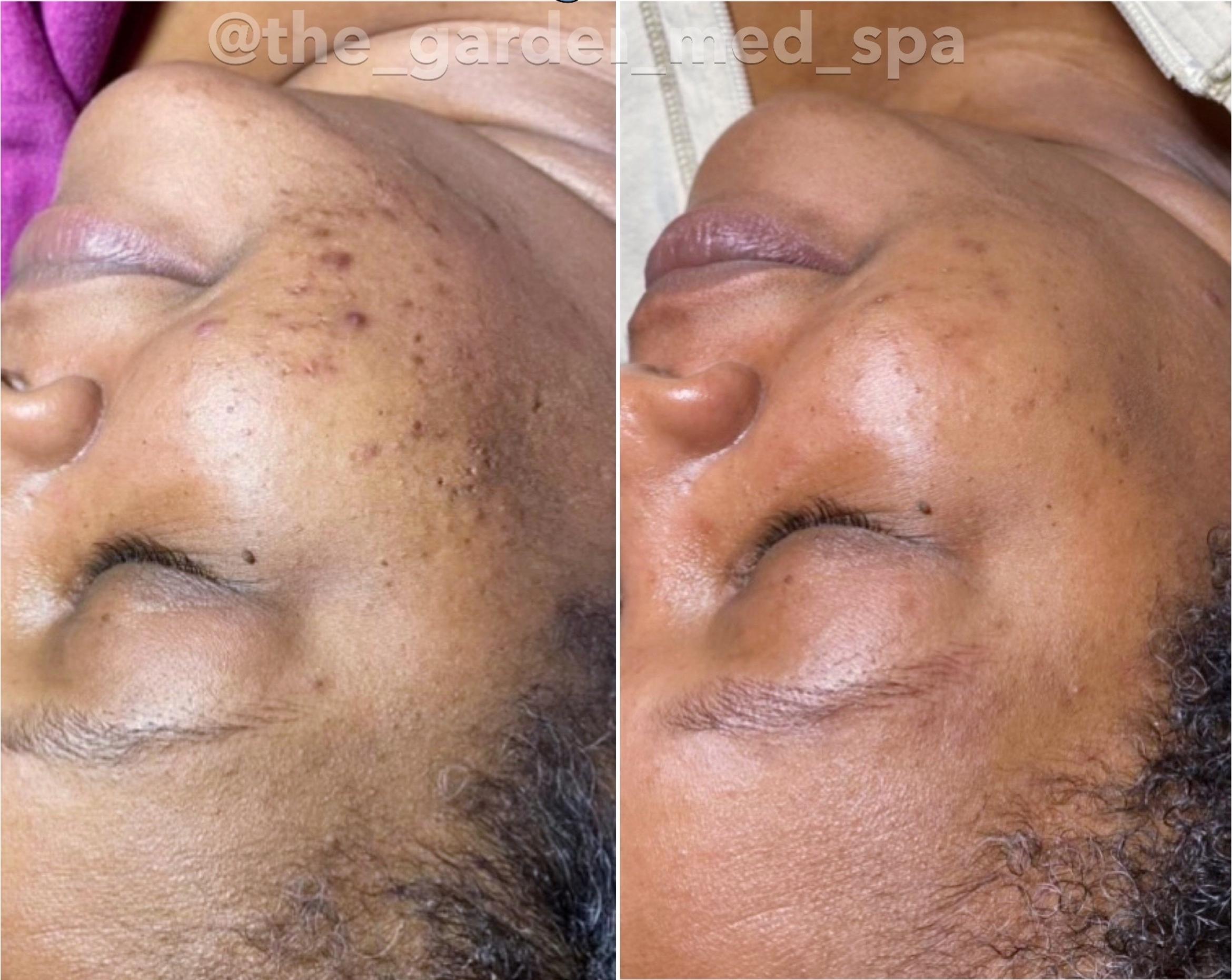 Before & After Chemical Peels Client #31 Left Side View in Tampa Bay, North Palm Beach, FL