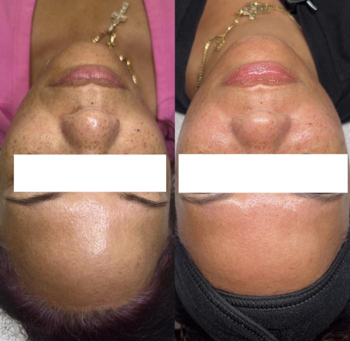 Before & After Hydrafacial™ Client #60 Front View in Tampa Bay, North Palm Beach, FL