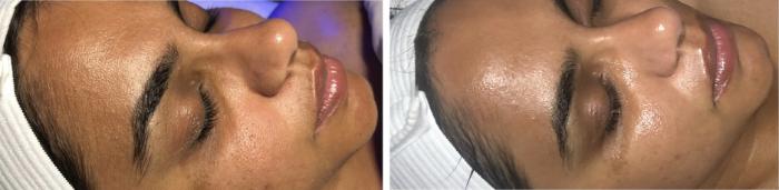 Before & After Chemical Peels Client #79 Right Side View in Tampa Bay, North Palm Beach, FL