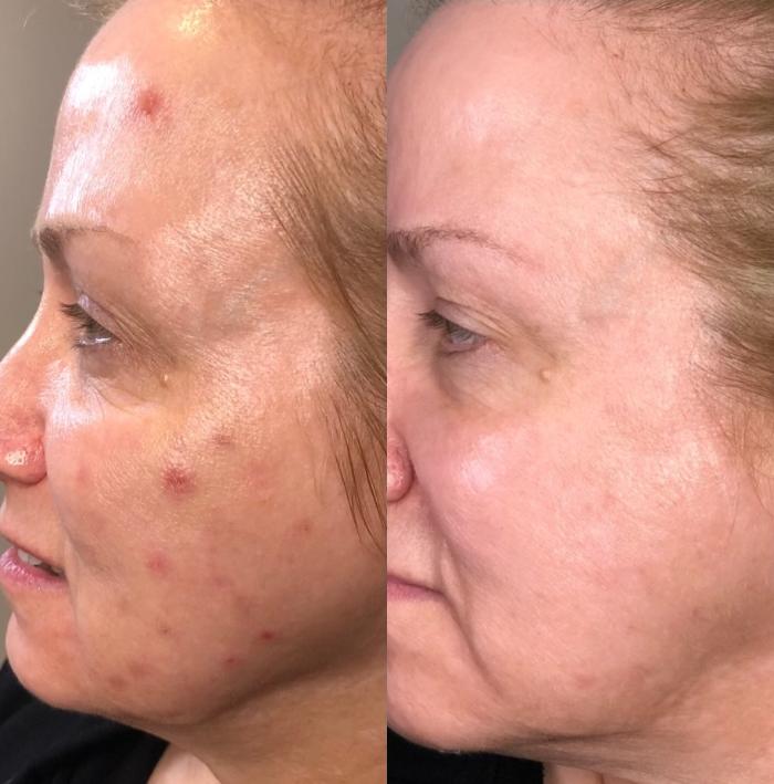 Before & After Chemical Peels Client #82 Left Side View in Tampa Bay, North Palm Beach, FL