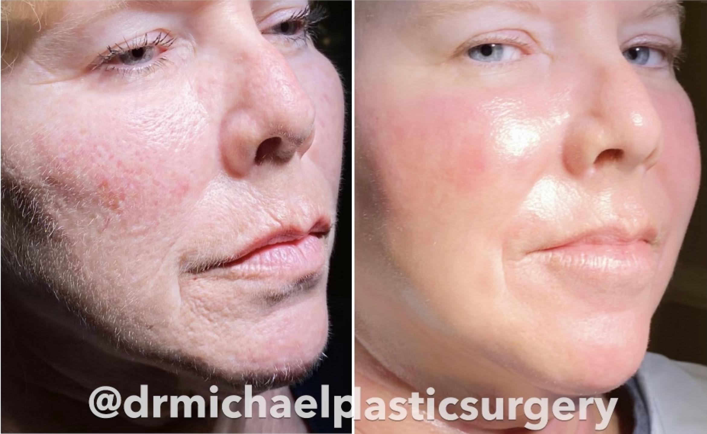 Before & After CO2 Laser Skin Resurfacing Client #70 Right Side View in Pinellas Park, Clearwater, St. Petersburg, North Palm Beach
