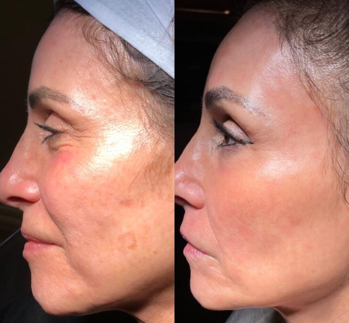 Before & After CO2 Laser Skin Resurfacing Client #77 Right Side View in Pinellas Park, Clearwater, St. Petersburg, North Palm Beach