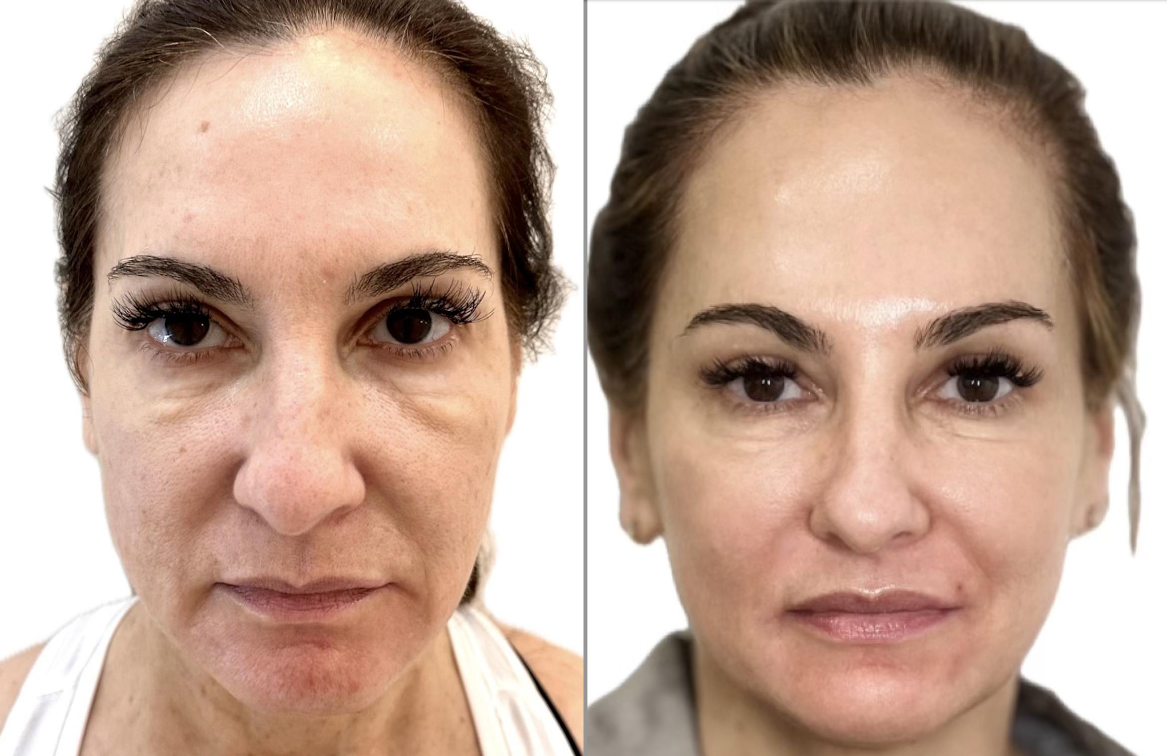 Before & After Dermal Fillers Client #10 Front View in Tampa Bay, North Palm Beach, FL