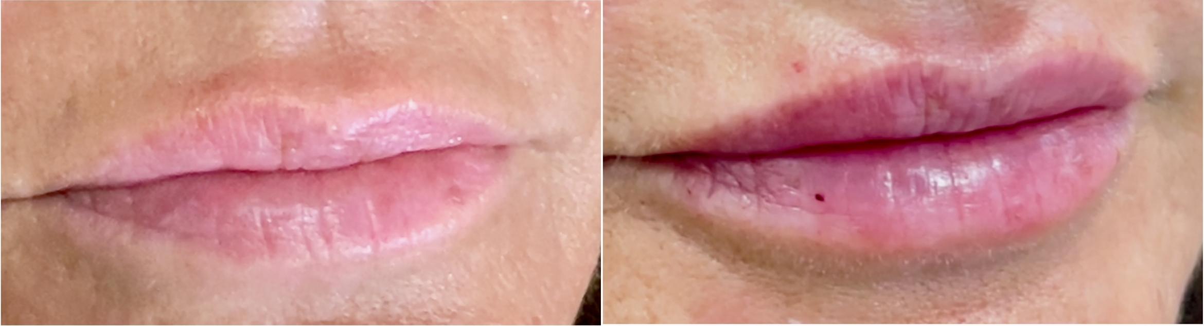 Correct Asymmetry with Lip Filler