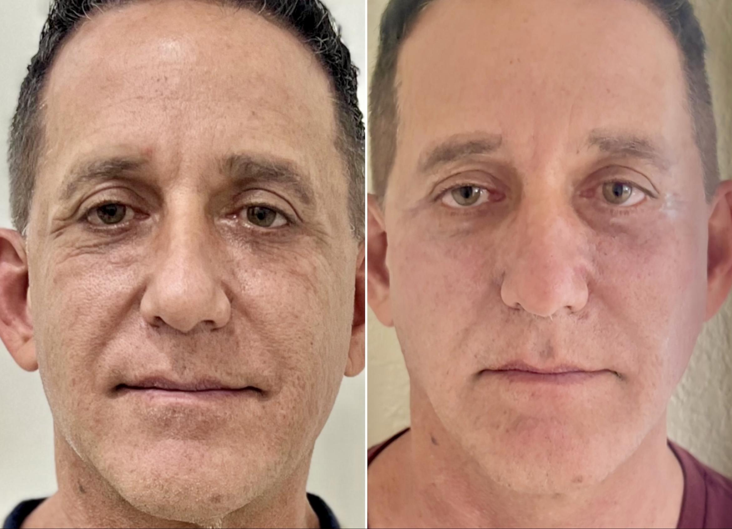 Facial Rejuvenation