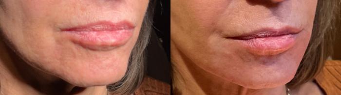 Lower Face Rejuvenation with Filler