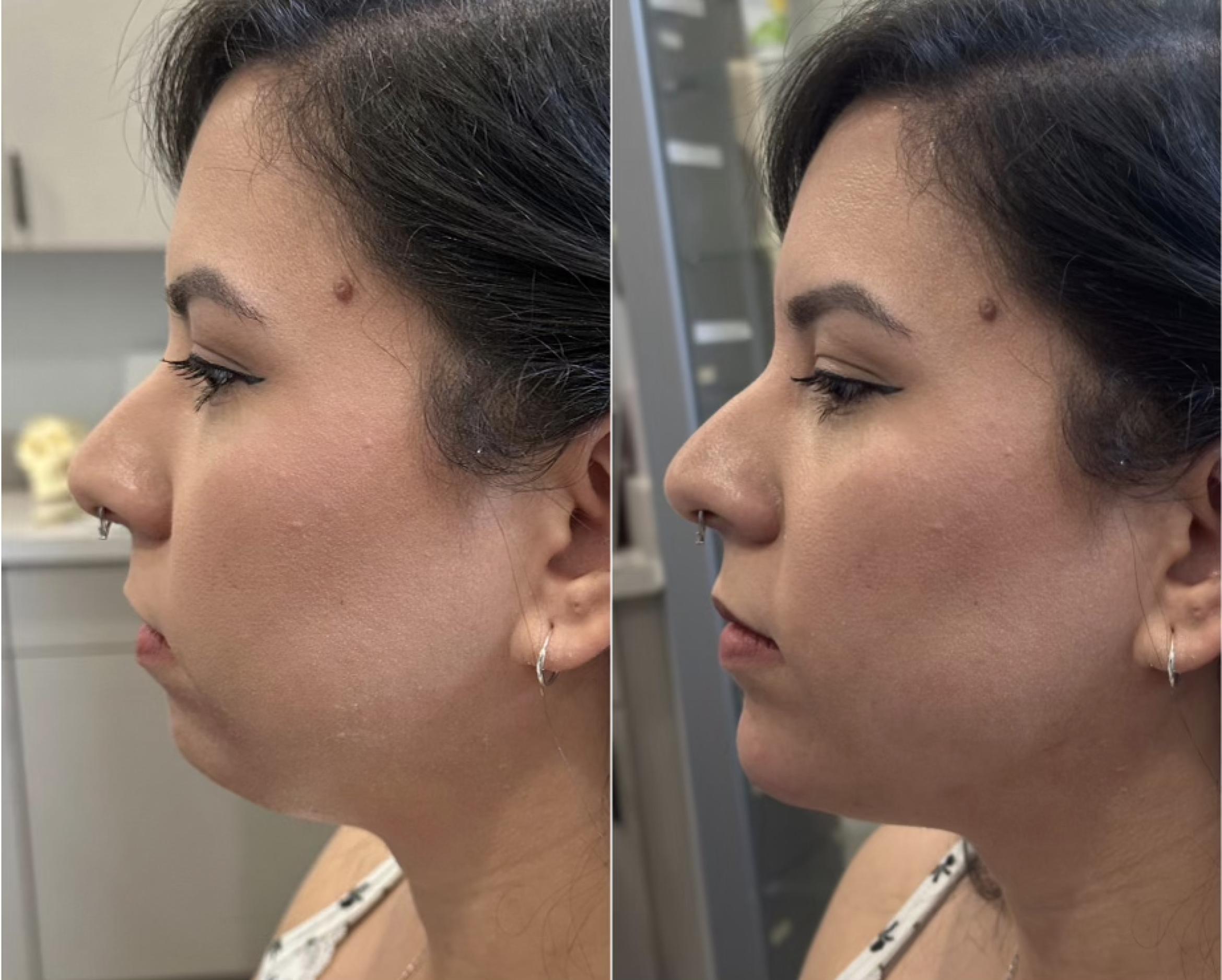 Dermal Filler for Chin & Jawline