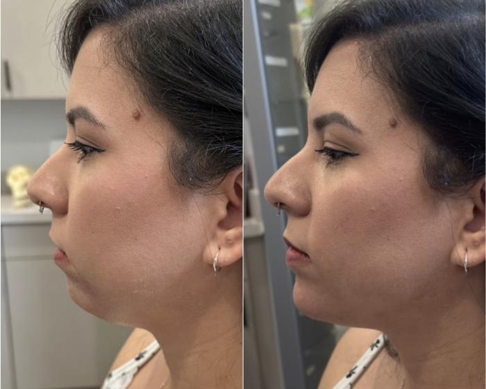 Dermal Filler for Chin & Jawline