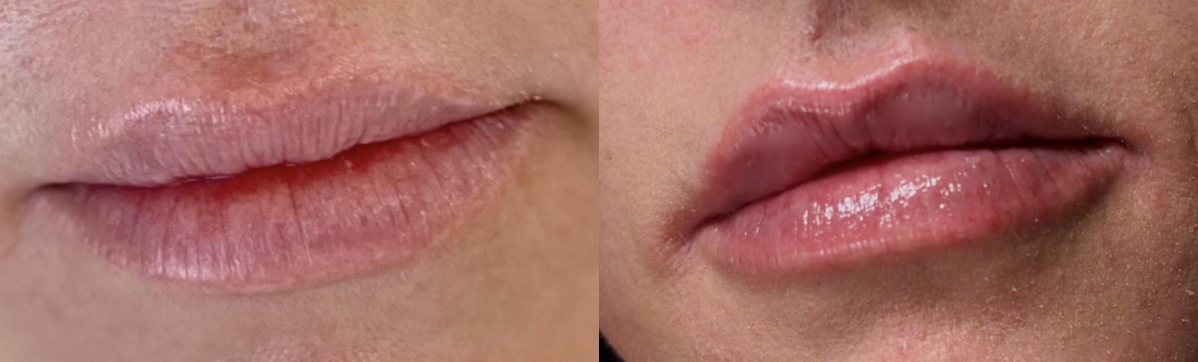 Before Dissolving Filler & After Refilling Filler