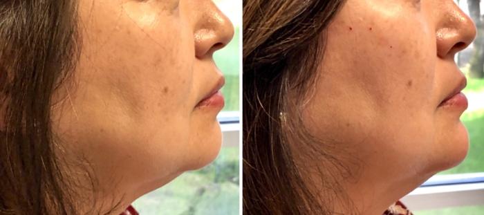 Natural Cheek & Chin Facial Balancing