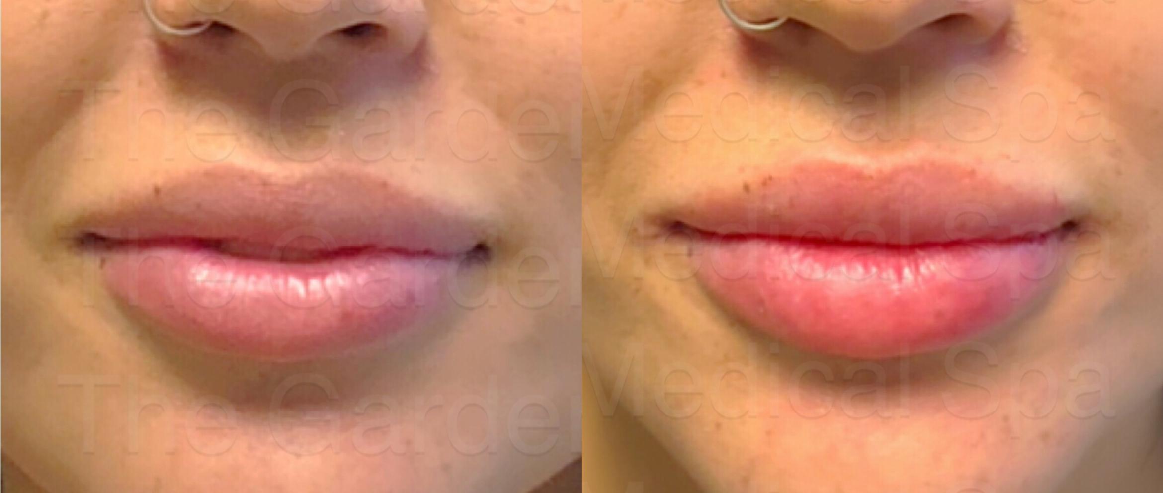 Lip Filler for Natural Augmentation