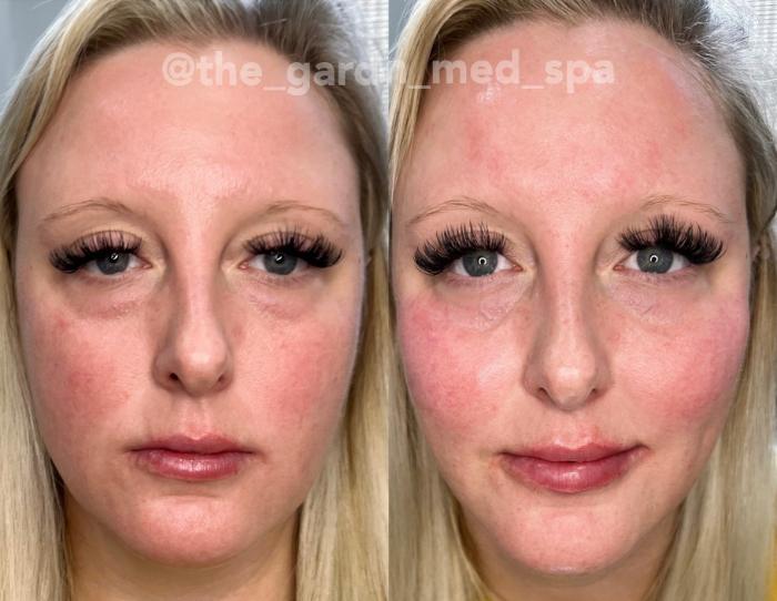 The Garden Glam Up ( Custom Placed filler & Botox)