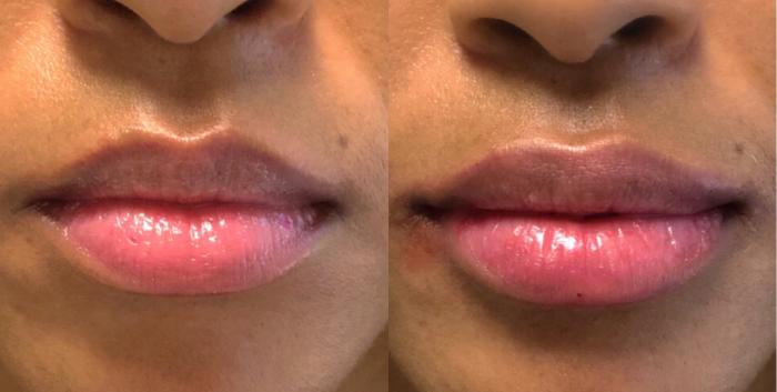 Lip Enhancing with Filler