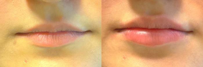 Natural Looking Lip Filler