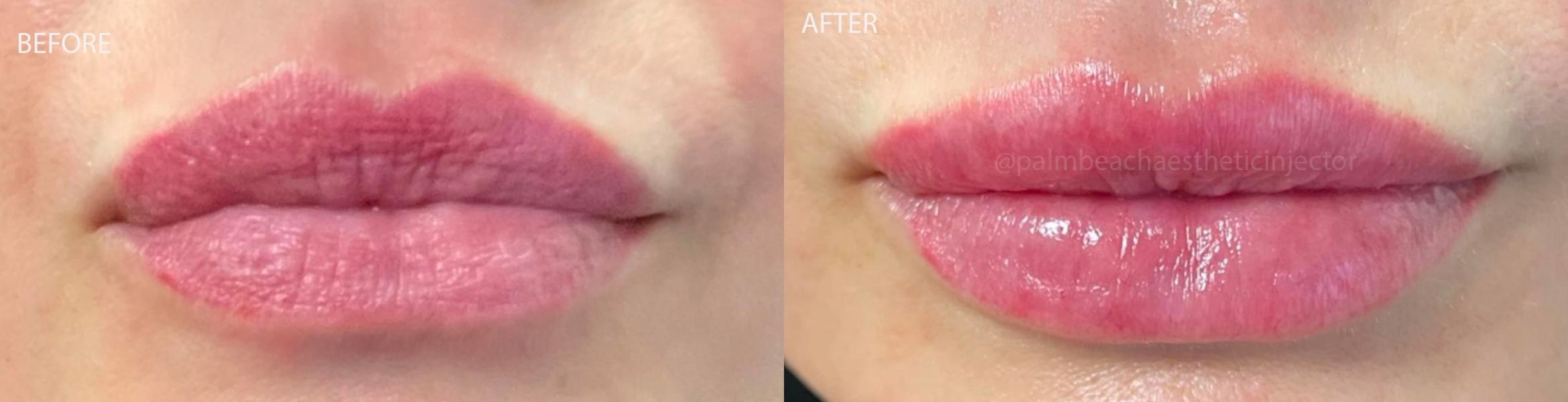 Before & After Dermal Fillers Client #144 Front View in Tampa Bay, North Palm Beach, FL