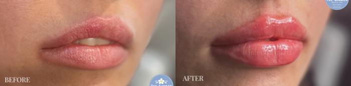 Russian Lip Filler Technique