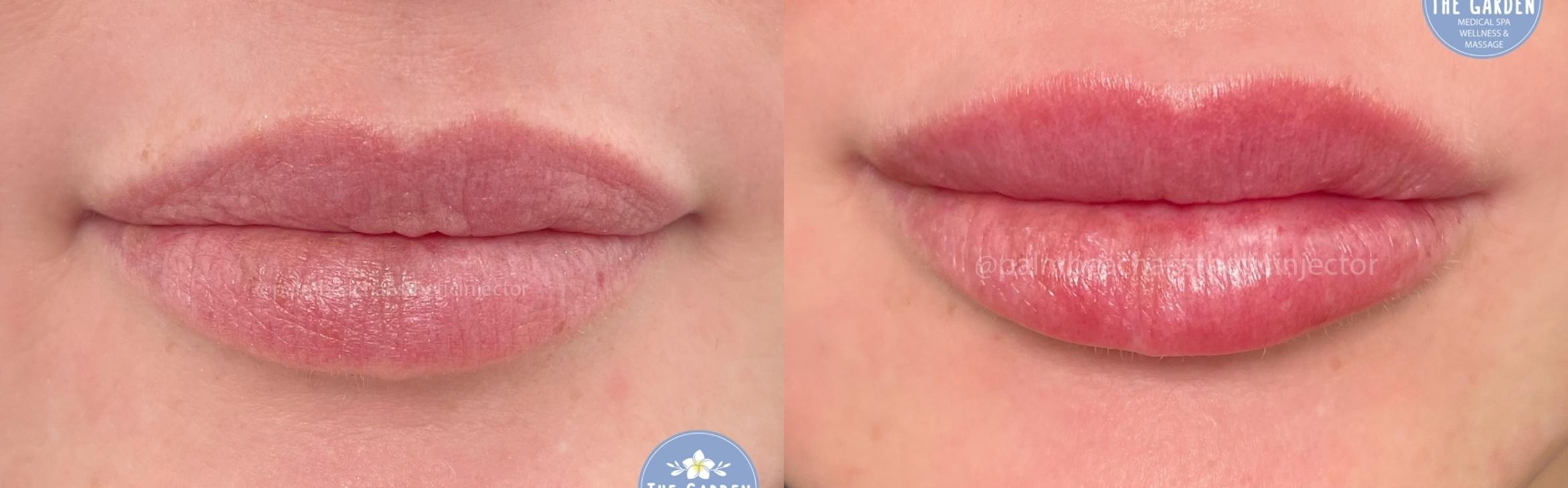 Lip Filler for Natural Enhacement