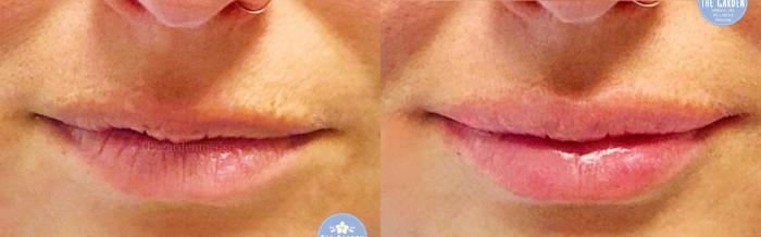 Lip Filler for Symmetry 
