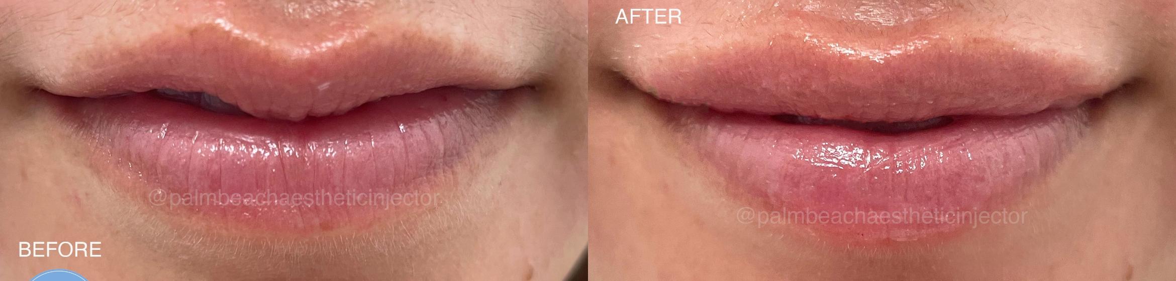 Lip Filler for Natural Volume