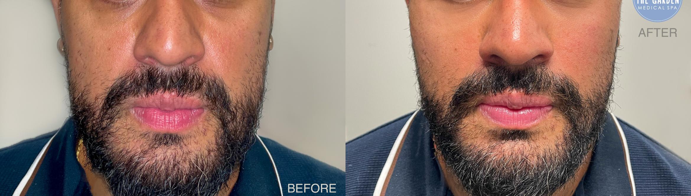 Male Filler for Facial Balancing