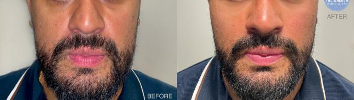 Male Filler for Facial Balancing