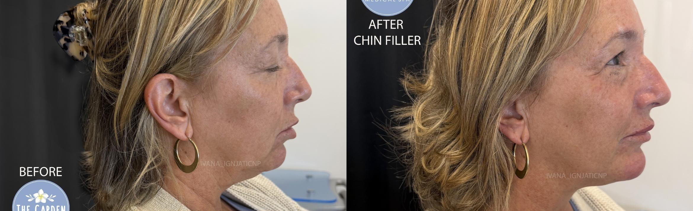 Chin Filler