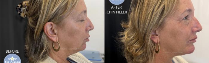 Chin Filler