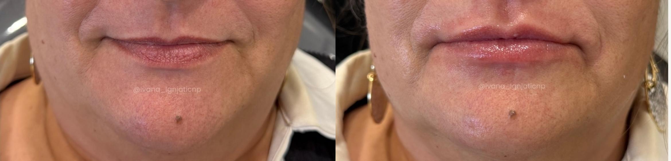 Lip Filler